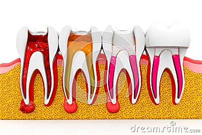 stages of root canal treatment Cartoon Illustration