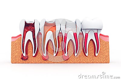 stages of root canal treatment Cartoon Illustration