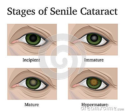 Stages of Senile Cataracts Vector Illustration