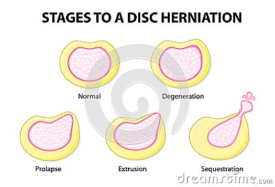 Stages to a disc herniation Vector Illustration