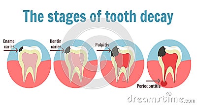 The stages of tooth decay infographic. Dental toothache symbol Vector Illustration