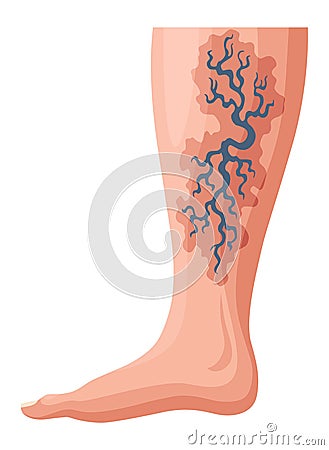 Stages or types of varicose veins development. Medical poster or disease infographic. Image of diseased legs. Vector Vector Illustration