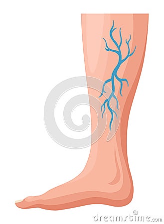 Stages or types of varicose veins development. Medical poster or disease infographic. Image of diseased legs. Vector Vector Illustration