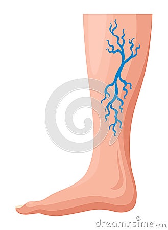 Stages or types of varicose veins development. Medical poster or disease infographic. Image of diseased legs. Vector Vector Illustration