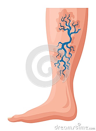 Stages or types of varicose veins development. Medical poster or disease infographic. Image of diseased legs. Vector Vector Illustration