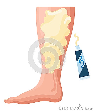 Stages or types of varicose veins development. Medical poster or disease infographic. Image of diseased legs. Vector Vector Illustration