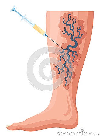 Stages or types of varicose veins development. Medical poster or disease infographic. Image of diseased legs. Vector Vector Illustration