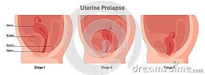 Stages of uterine prolapse. Pelvic floor muscles weakening, Support Vector Illustration