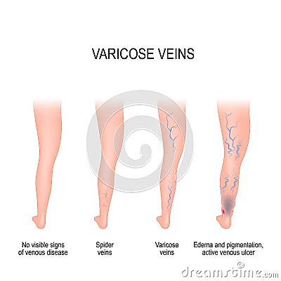 Stages of varicose veins. Vector Illustration