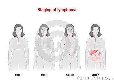 Staging of lymphoma. Woman silhouette with highlighted internal Vector Illustration