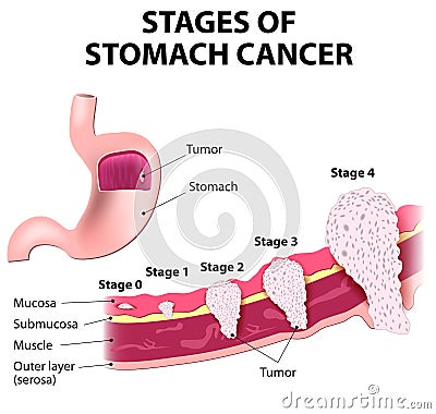 Staging of stomach cancer Vector Illustration