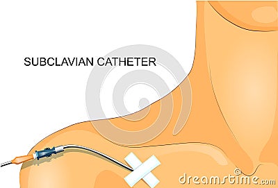 The staging of the subclavian catheter Vector Illustration