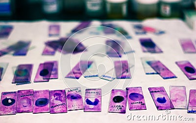Stained glass slides of peripheral blood smear with violet leishman giemsa stain in hematology pathology laboratory Stock Photo