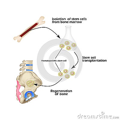 Stem cells from bone marrow are used for bone regeneration. Infographics. Vector illustration Vector Illustration