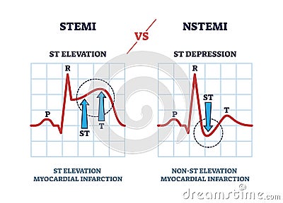 STEMI vs NSTEM heart beat impulse in cardio visualization outline diagram Vector Illustration