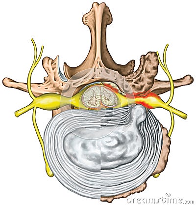 Stenosis, lumbar disk herniation VS good vertebra Stock Photo