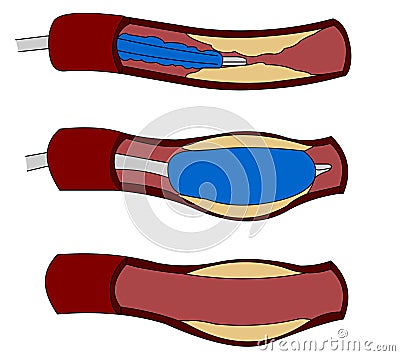 Stent Vector Illustration