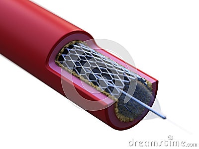 A stent in action Cartoon Illustration