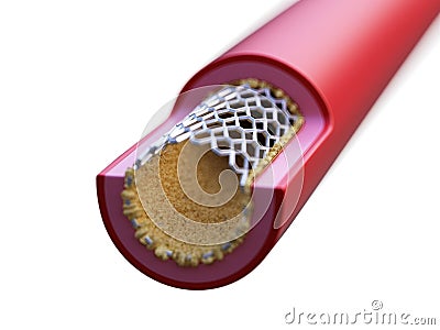 A stent in action Cartoon Illustration