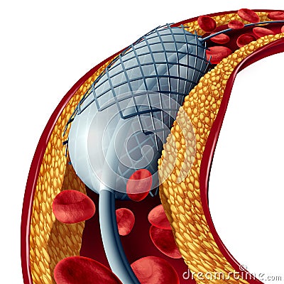 Stent And Angioplasty Isolated Cartoon Illustration