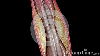 Stent Angioplasty Procedure,3D Animation Stock Video - Video of biology,  medicine: 119535449
