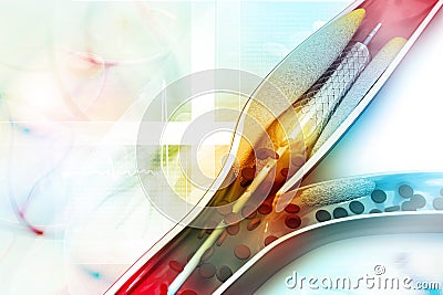 Stent angioplasty Stock Photo