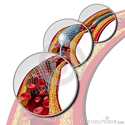 Stent Coronary Medical Concept Cartoon Illustration