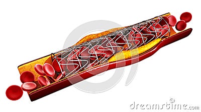 Stent implant concept as a heart disease treatment. illustration. isolated white Cartoon Illustration
