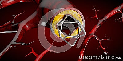 Stent medical implant concept as a heart disease treatment symbol 3D illustration. Cartoon Illustration