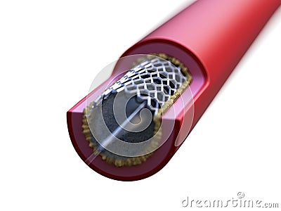 Stent placed in an artery Cartoon Illustration