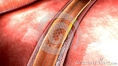 Stent Stock Photo