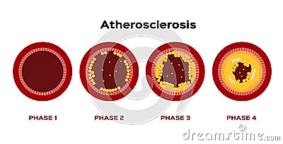 Step of Atherosclerosis graphic vector . fat stuck in the blood artery cholesterol Vector Illustration