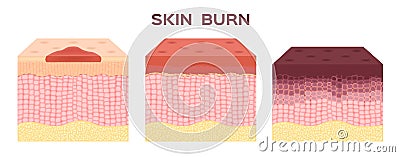 Step of burn . Normal to serious burn skin . vector and icon Vector Illustration
