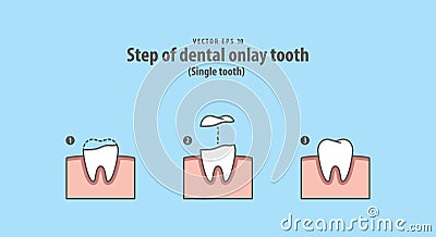 Step of dental onlay tooth Single tooth illustration vector on Vector Illustration