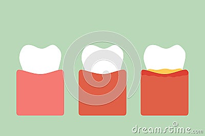 Step of gum disease Vector Illustration