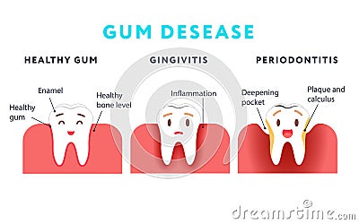 Step of gum disease. Healthy tooth and gingivitis Vector Illustration