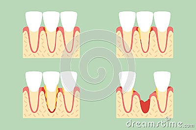 Step of periodontal disease or gingivitis of incisor tooth Vector Illustration