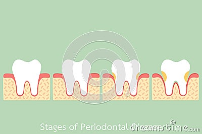 Step of periodontal disease / periodontitis / gingivitis / gum disease, dental problem Vector Illustration