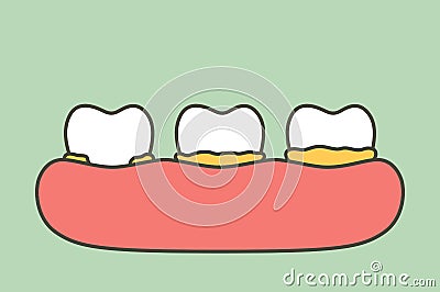 Step of plaque or tartar , cause of tooth periodontal disease Vector Illustration