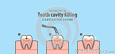 Step of tooth cavity filling cross-section structure inside toot Vector Illustration