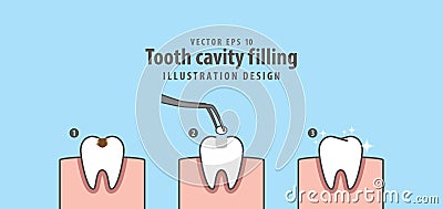 Step of tooth cavity filling illustration vector on blue background. Dental concept. Vector Illustration