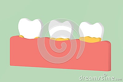 Step of tooth periodontal disease with dental plaque or tartar Stock Photo