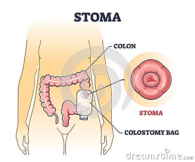 Stoma bag after colon surgery as medical patient drainage outline diagram Vector Illustration