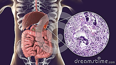 Stomach adenocarcinoma, gastric cancer, illustration and light micrograph Cartoon Illustration