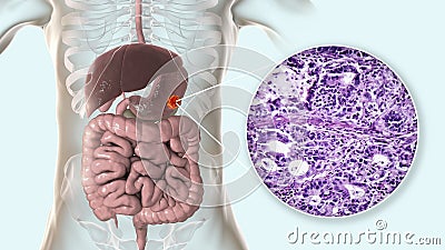 Stomach adenocarcinoma, gastric cancer, illustration and light micrograph Cartoon Illustration