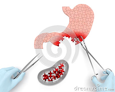 Stomach cancer operation Stock Photo