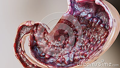 Stomach cancer. stages tumor growth in digestive system, Peptic Ulcer, Cancer attacking cell. gastric malignant cancerous Stock Photo