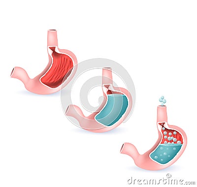 Stomach and digestive. GERD, full and empty human`s stomach Vector Illustration