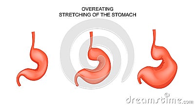 The stomach,distended from overeating Vector Illustration