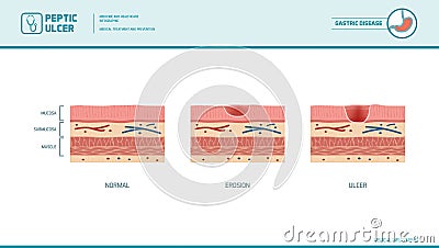 Stomach erosion and peptic ulcer Vector Illustration